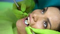 Sealant placement on central incisor, cosmetic dentistry for chipped tooth