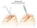 Sebaceous cyst