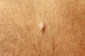 Sebaceous cyst on the back of the male