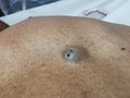 SEBACEOUS cyst with punctum on the abdominal wall skin