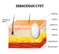 Sebaceous cyst or trichilemmal cyst Royalty Free Stock Photo