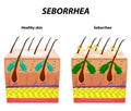 Seborrhea skin and hair. Dandruff seborrheic dermatitis. Eczema. Dysfunction of the sebaceous glands. Inflammatory skin disease. Royalty Free Stock Photo