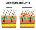 Seborrhea skin and hair. Dandruff seborrheic dermatitis. Eczema. Dysfunction of the sebaceous glands. Inflammatory skin Royalty Free Stock Photo