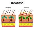 Seborrhea skin and hair. Dandruff seborrheic dermatitis. Eczema. Dysfunction of the sebaceous glands. Inflammatory skin Royalty Free Stock Photo