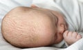 Seborrheic dermatitis crusts on the baby`s head. child with seborrhea in the hair