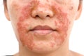 Seborrheic Dermatitis on face Royalty Free Stock Photo