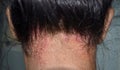 Seborrheic dermatitis or fungal skin infection at the scalp of Southeast Asian, Myanmar adult female patient