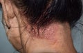 Seborrheic dermatitis or fungal skin infection at the scalp of Southeast Asian, Myanmar adult female patient