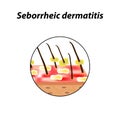 Seborrheic dermatitis of the skin and hair. Dandruff, seborrhea. Baldness, hair growth, baldness. Anatomical structure Royalty Free Stock Photo