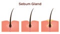 Sebum oil gland in human skin