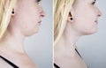 Second chin lift in women. Photos before and after plastic surgery, mentoplasty or facebuilding. Chin fat removal and face contour Royalty Free Stock Photo