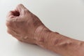 Second degree burn at left forearm and wrist Royalty Free Stock Photo