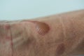 Second degree burn at left forearm and wrist Royalty Free Stock Photo