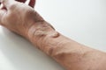 Second degree burn at left forearm and wrist Royalty Free Stock Photo