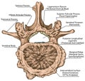 BOARD Advanced uncovertebral arthrosis of the second lumbar vertebra Royalty Free Stock Photo