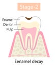 Tooth decay symptom, Enamel decay results in dental cavity formation. Dental and oral care health concept