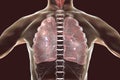 Secondary tuberculosis in lungs