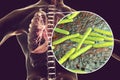 Secondary tuberculosis in lungs and close-up view of Mycobacterium tuberculosis bacteria