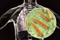 Secondary tuberculosis in lungs and close-up view of Mycobacterium tuberculosis bacteria