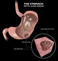 Section 3d of the stomach. Peptic ulcer disease, gastric ulcer is a break in the inner lining of the stomach