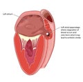 Heart left atrial appendage