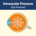 Section of human eye showing intraocular pressure buildup in Glaucoma disease