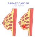 Sectional tumor and breast cancer