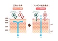 Sectional view of atopic dermatitis and normal skin / Comparative vector illustration Japanese