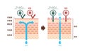 Sectional view of atopic dermatitis and normal skin / Comparative vector illustration Japanese