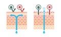 Sectional view of atopic dermatitis and normal skin / Comparative vector illustration no text