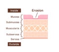 Sectional view illustration of gastric erosion