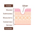 Sectional view illustration  of gastric ulcer Royalty Free Stock Photo