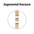 Segmental fracture Bone. Infographics. Vector illustration on a lined background.