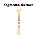 Segmental fracture Bone. Infographics. Vector illustration on a lined background. Royalty Free Stock Photo