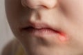 Seizures on the corners of the lips of a child s mouth. Bacterial disease of inflammation of the corners of the lips