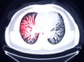 Selective Focus of CT Chest AXIAL MIP view for diagnostic Pulmonary embolism PE.