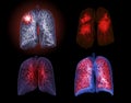 Selective focus of CT Chest or Lung 3D rendering image on the monitor for diagnosis TB,tuberculosis and covid-19