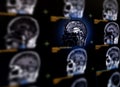 Selective focus of MRI brain sagittal plane for detect a variety of conditions of the brain. Royalty Free Stock Photo