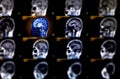 Selective focus of MRI brain sagittal plane Royalty Free Stock Photo