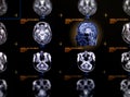 Selective focus of MRI brain sagittal view Royalty Free Stock Photo