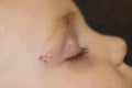 Selective focus. Profile of the toddler with surgical sutures on the face. Two sutures under the eyebrow, macro Royalty Free Stock Photo