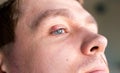 Selective focus on swollen and painful red upper eye lid with onset of stye infection due to clogged oil gland and Royalty Free Stock Photo