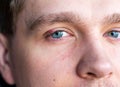 Selective focus on swollen and painful red upper eye lid with onset of stye infection due to clogged oil gland and Royalty Free Stock Photo