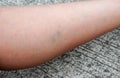 close up woman left leg with bruise pain