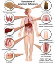 Selenium deficiency medical vector illustration isolated on white background infographic Royalty Free Stock Photo