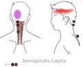 Semispinalis capitis trigger points can cause pain in the back and side of the head Royalty Free Stock Photo