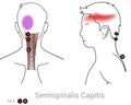 Semispinalis capitis trigger points can cause pain in the back and side of the head