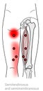 Semitendinosus and Semimembranosus trigger point referral pain areas