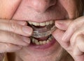 Senior man putting a night guard onto crooked teeth