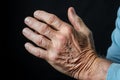 Senior citizens hands ache, a reminder of lifes wear and tear